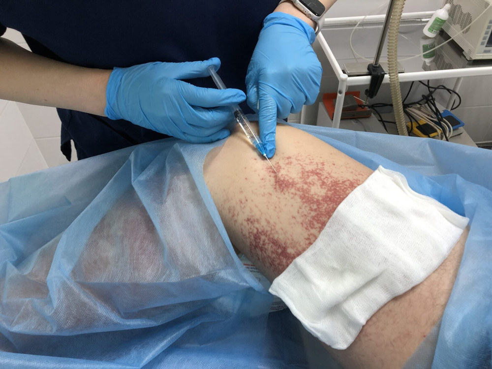 біопсія для діагностики раку